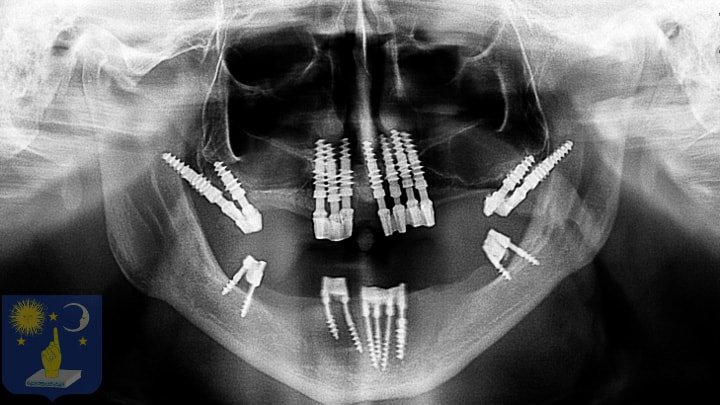 Implant basal pour patient édenté sans dents