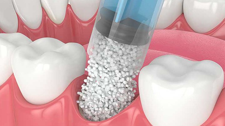 greffe os pour implant dentaire