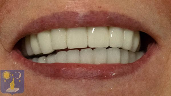 traitement parodontite avec implant dentaire basal