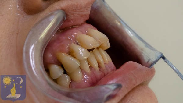 implant-basal-1200-parodontite